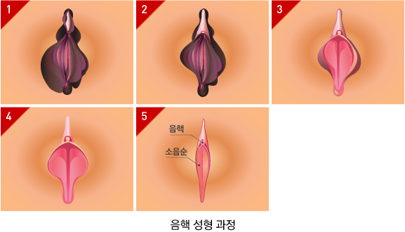 음핵 성형 과정